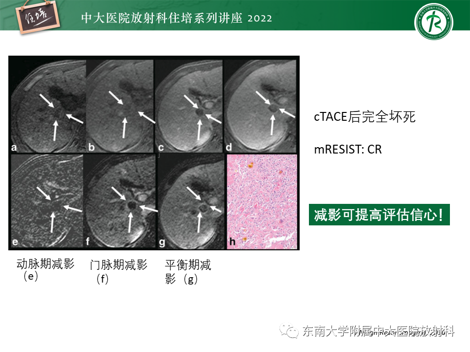 影像PPT - 【PPT】肝癌介入治疗后的磁共振评估-13