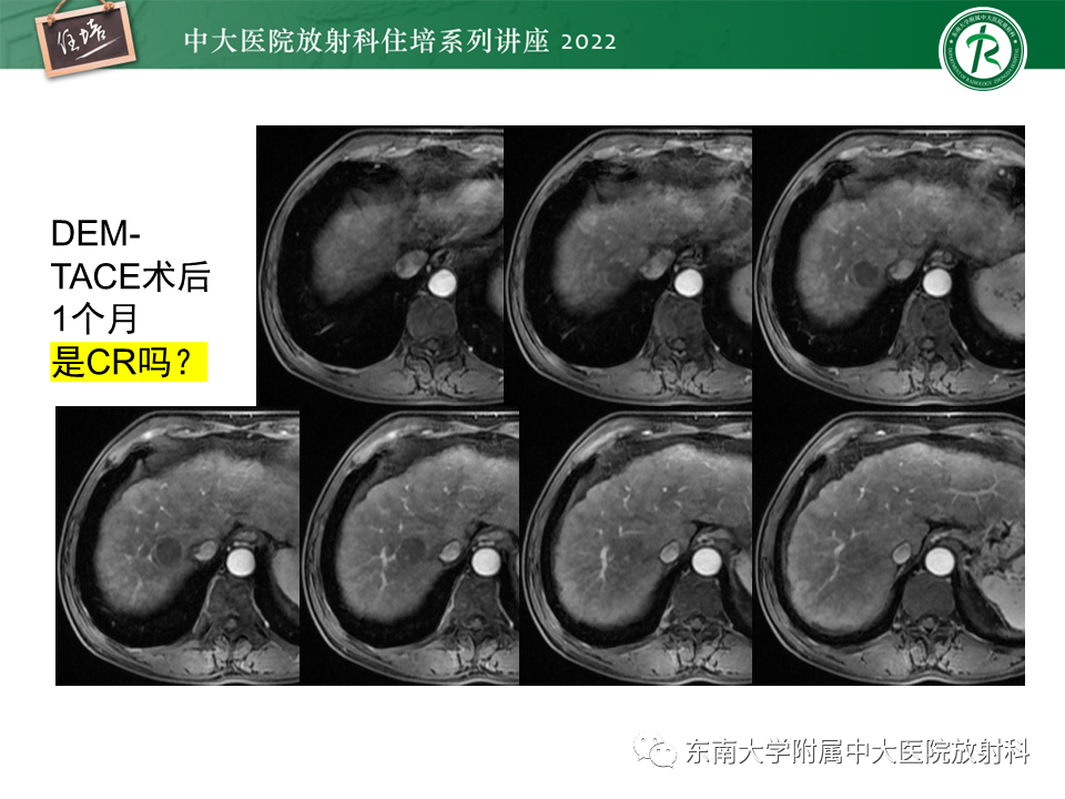 影像PPT - 【PPT】肝癌介入治疗后的磁共振评估-15