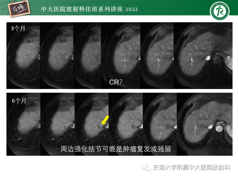 影像PPT - 【PPT】肝癌介入治疗后的磁共振评估-16