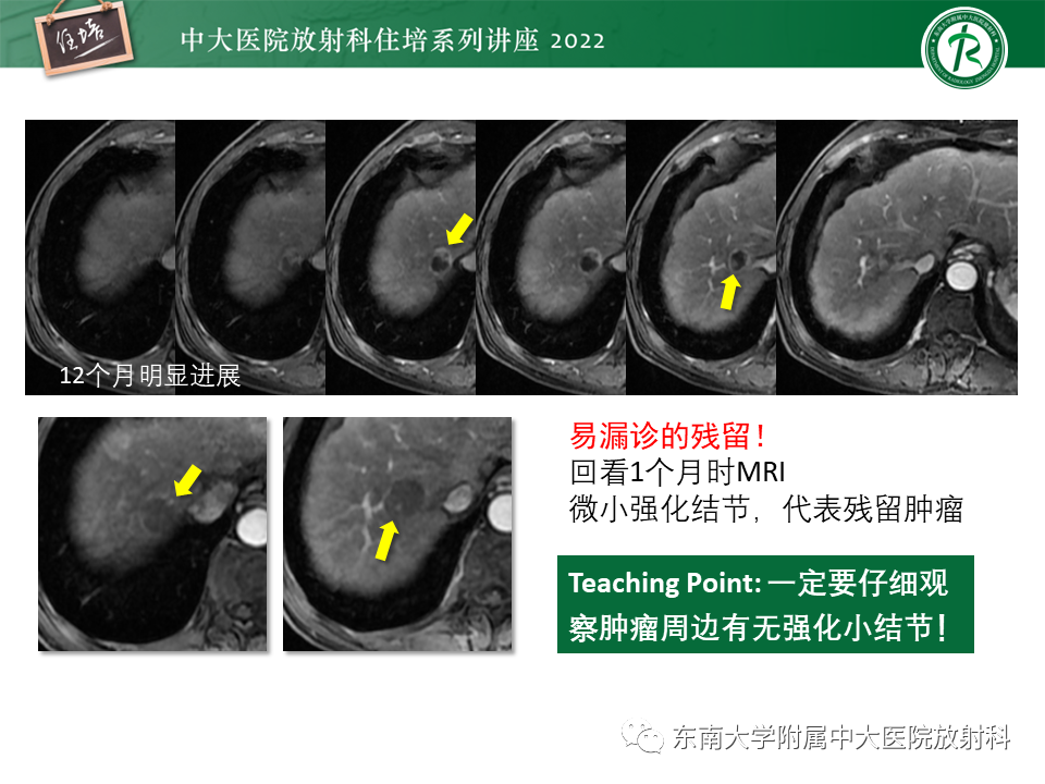 影像PPT - 【PPT】肝癌介入治疗后的磁共振评估-17