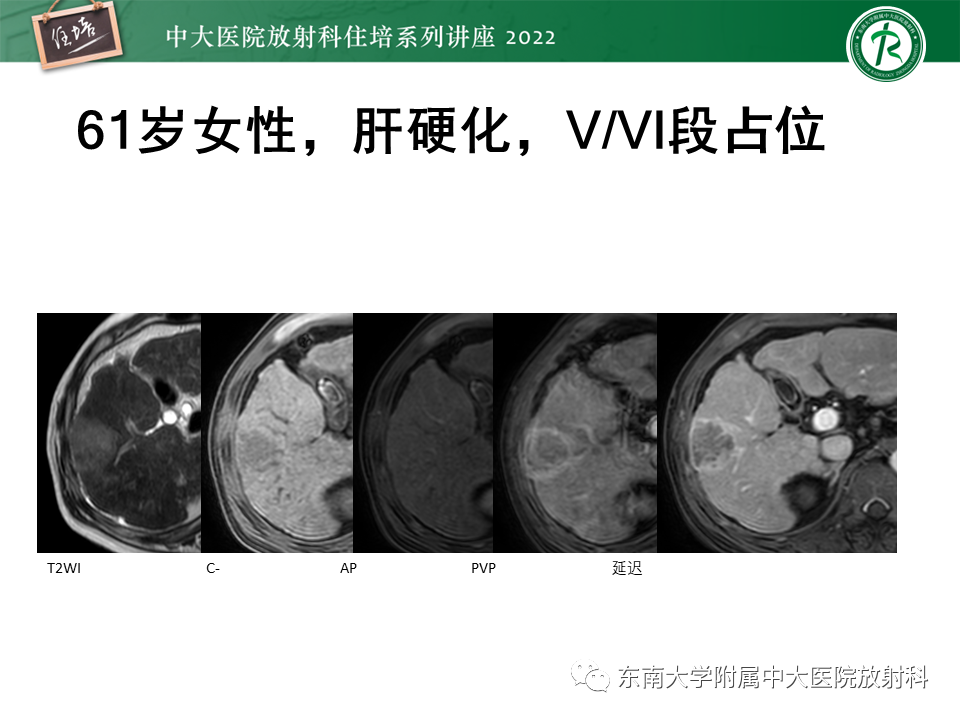 影像PPT - 【PPT】肝癌介入治疗后的磁共振评估-18