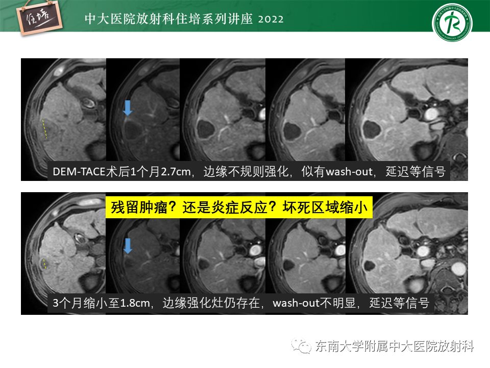 影像PPT - 【PPT】肝癌介入治疗后的磁共振评估-19