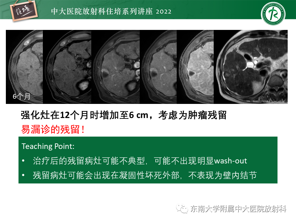 影像PPT - 【PPT】肝癌介入治疗后的磁共振评估-20