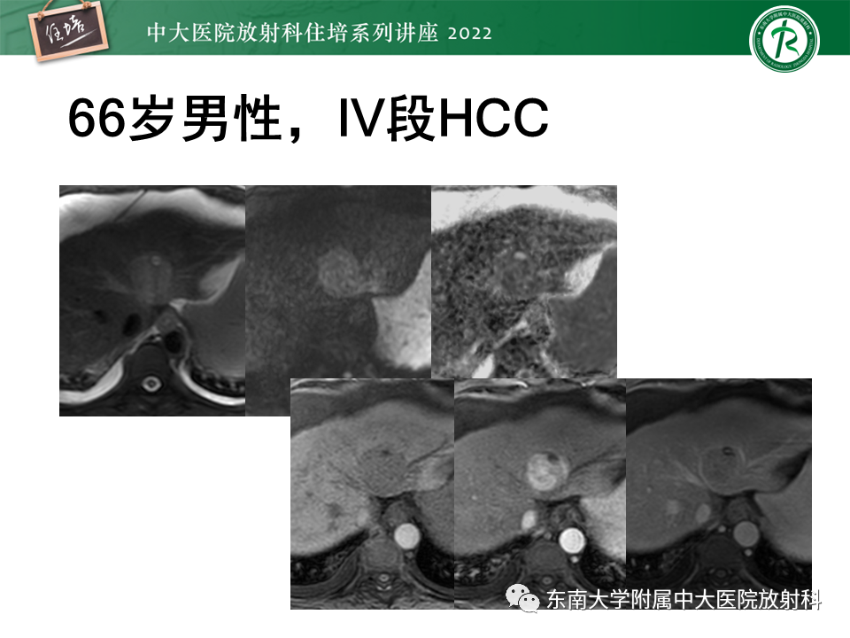 影像PPT - 【PPT】肝癌介入治疗后的磁共振评估-21