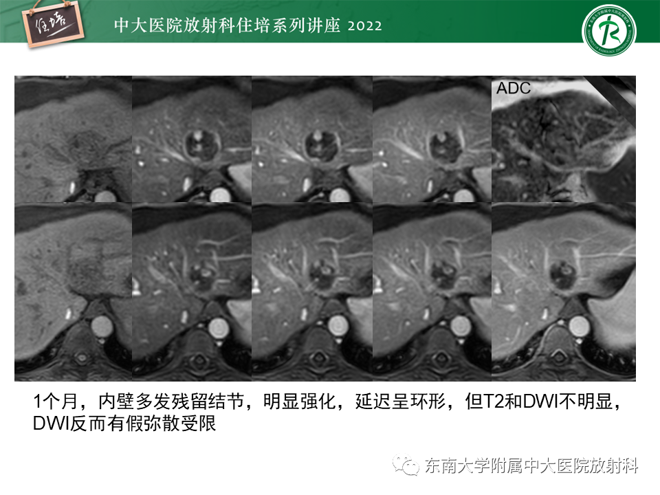 影像PPT - 【PPT】肝癌介入治疗后的磁共振评估-22