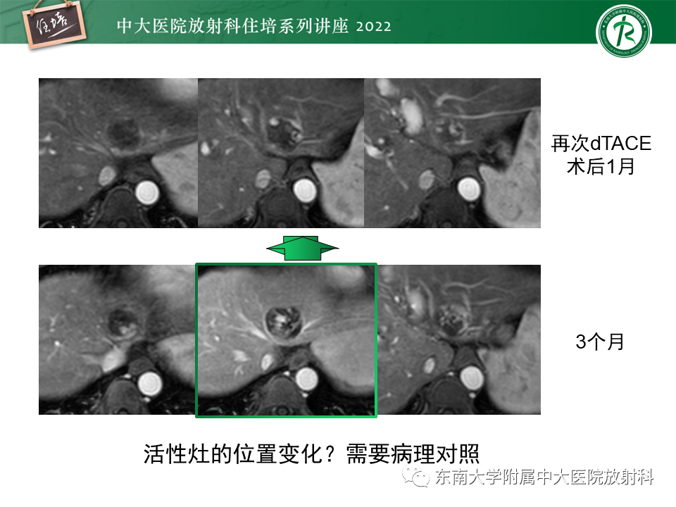 影像PPT - 【PPT】肝癌介入治疗后的磁共振评估-23