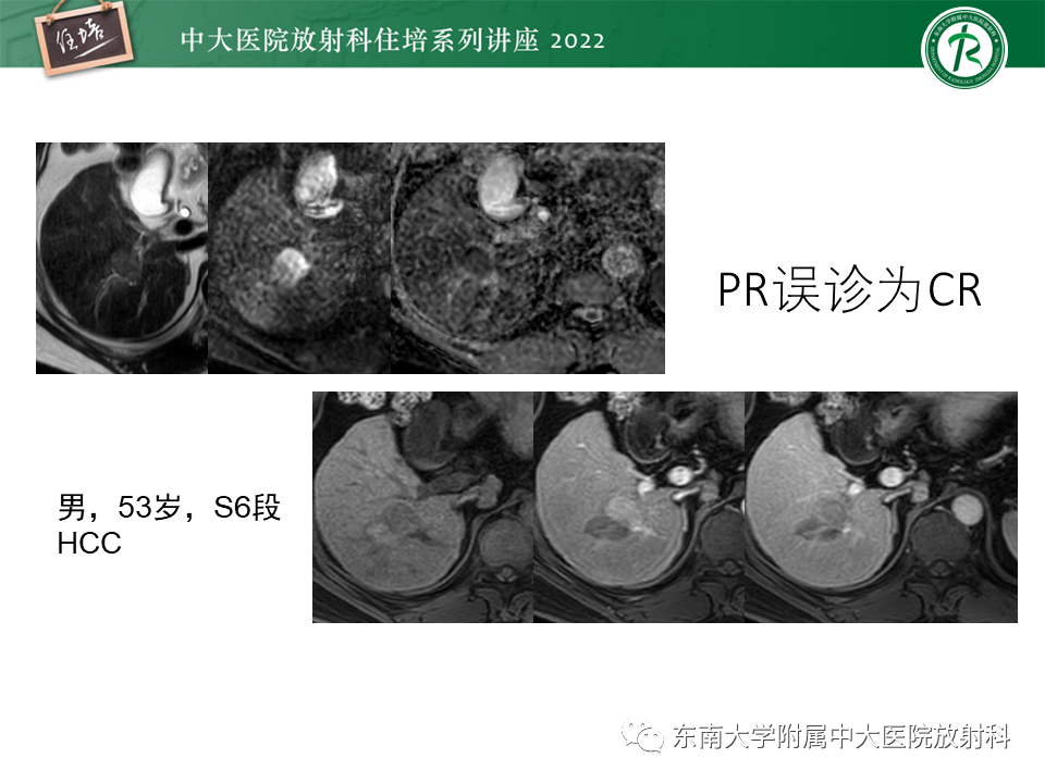 影像PPT - 【PPT】肝癌介入治疗后的磁共振评估-24