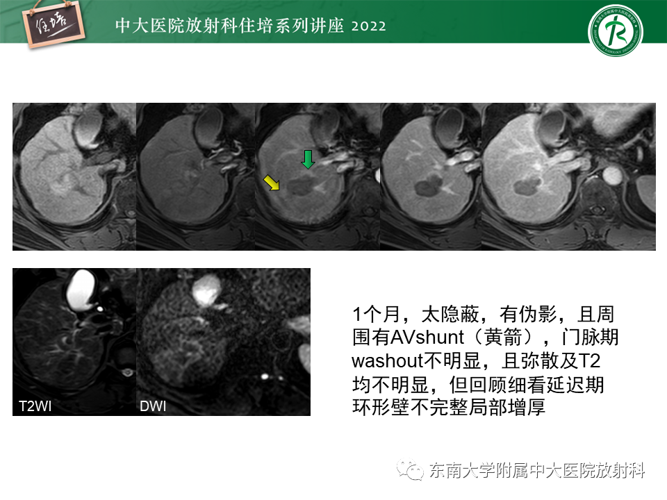 影像PPT - 【PPT】肝癌介入治疗后的磁共振评估-25