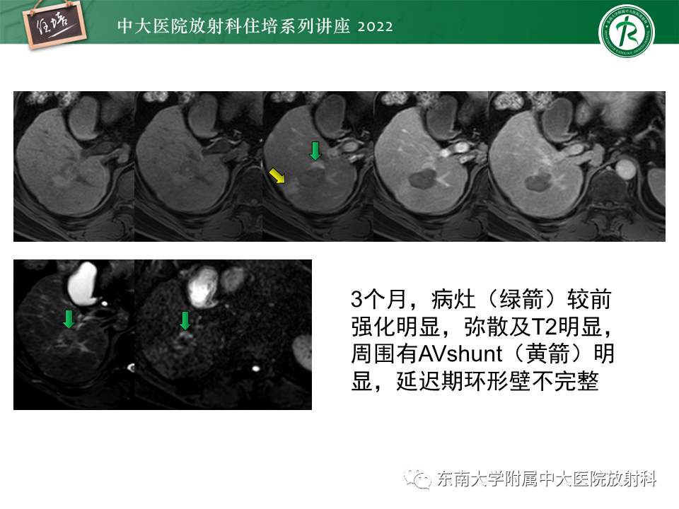 影像PPT - 【PPT】肝癌介入治疗后的磁共振评估-26