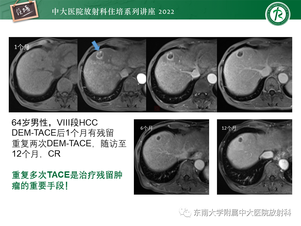 影像PPT - 【PPT】肝癌介入治疗后的磁共振评估-27
