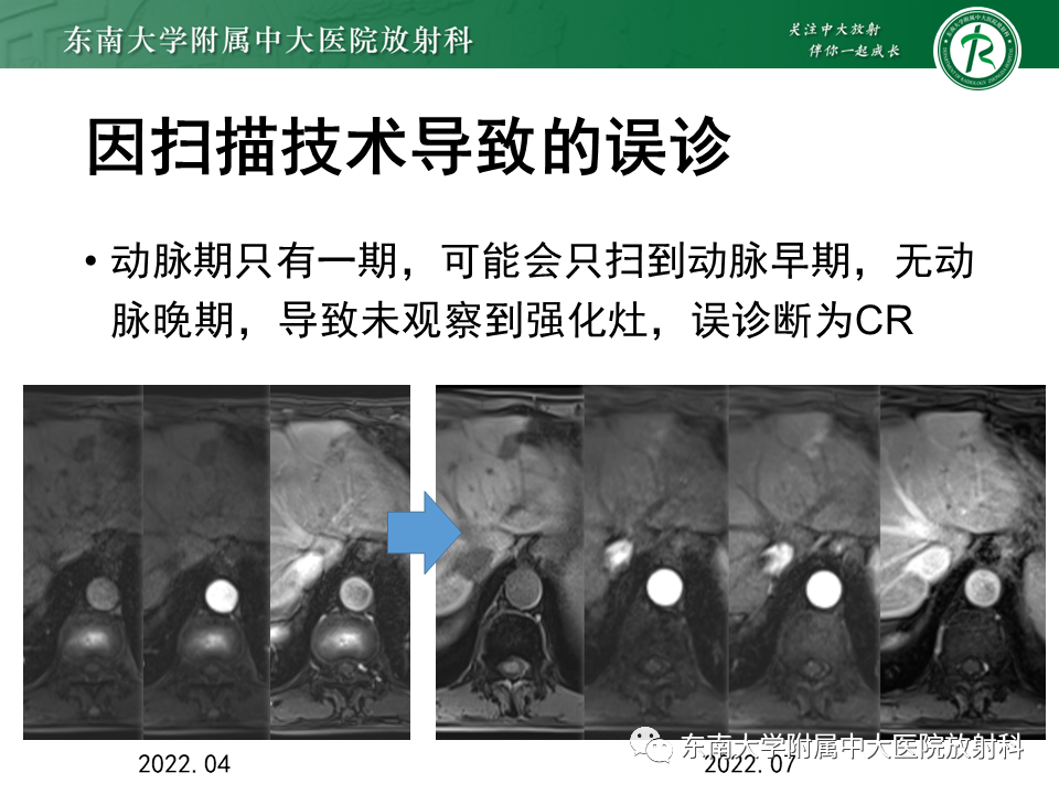 影像PPT - 【PPT】肝癌介入治疗后的磁共振评估-28