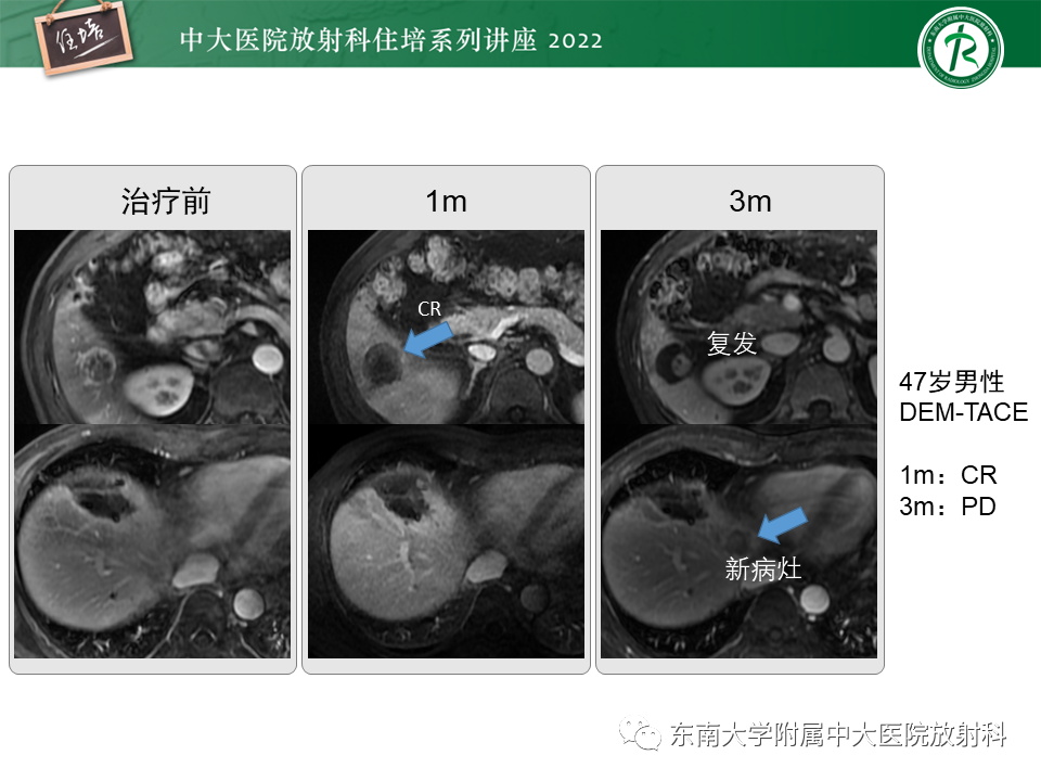 影像PPT - 【PPT】肝癌介入治疗后的磁共振评估-30