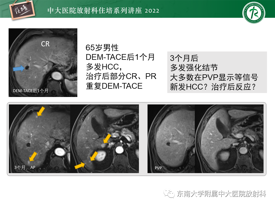 影像PPT - 【PPT】肝癌介入治疗后的磁共振评估-31