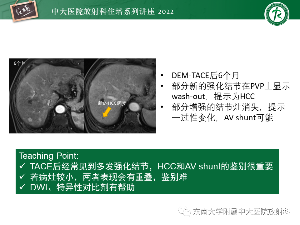 影像PPT - 【PPT】肝癌介入治疗后的磁共振评估-32