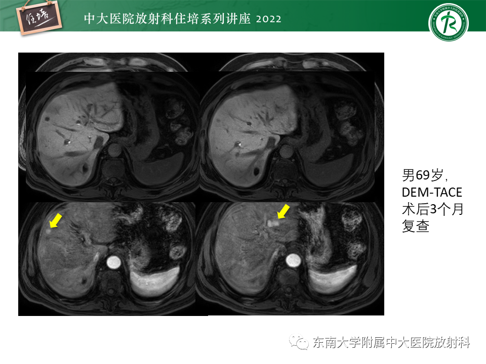 影像PPT - 【PPT】肝癌介入治疗后的磁共振评估-36