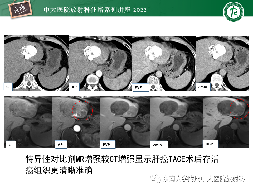 影像PPT - 【PPT】肝癌介入治疗后的磁共振评估-37