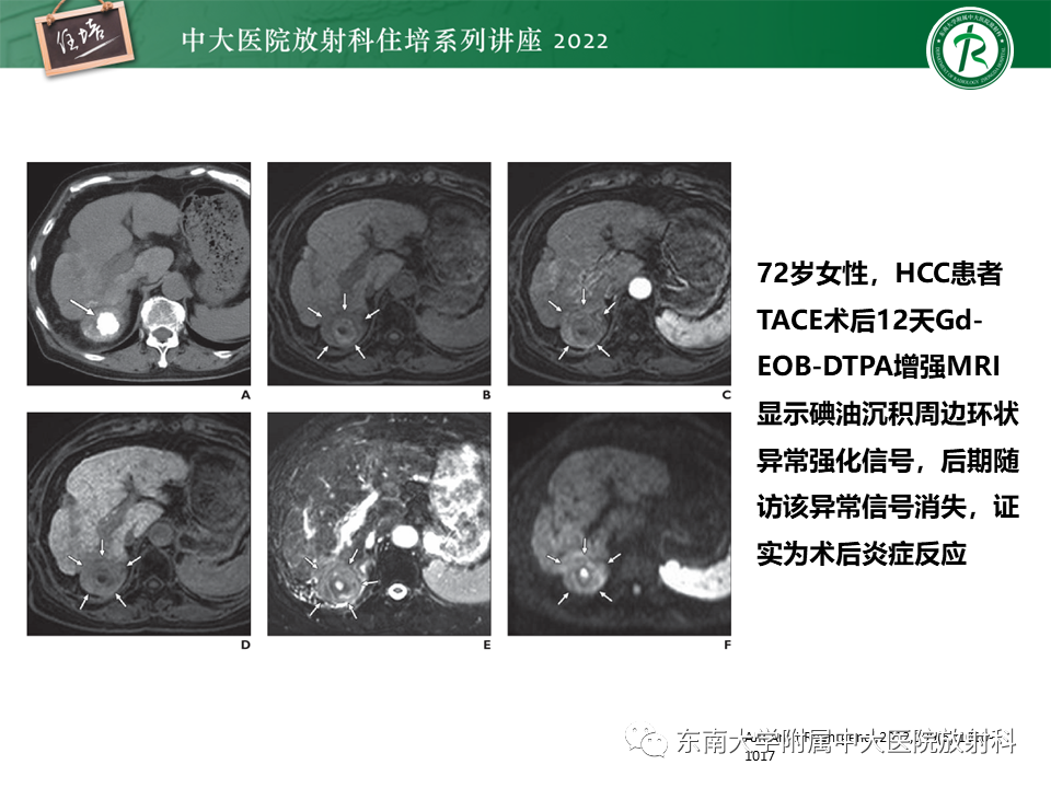 影像PPT - 【PPT】肝癌介入治疗后的磁共振评估-38
