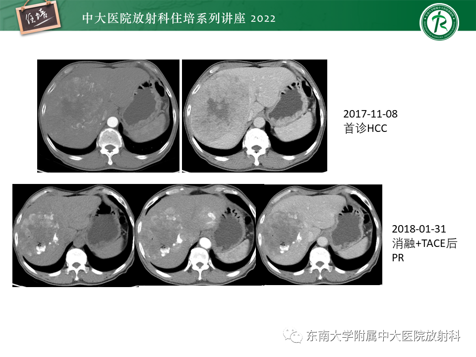 影像PPT - 【PPT】肝癌介入治疗后的磁共振评估-40