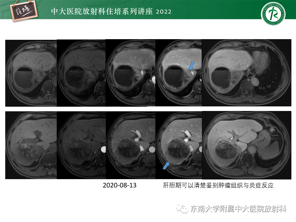 影像PPT - 【PPT】肝癌介入治疗后的磁共振评估-41