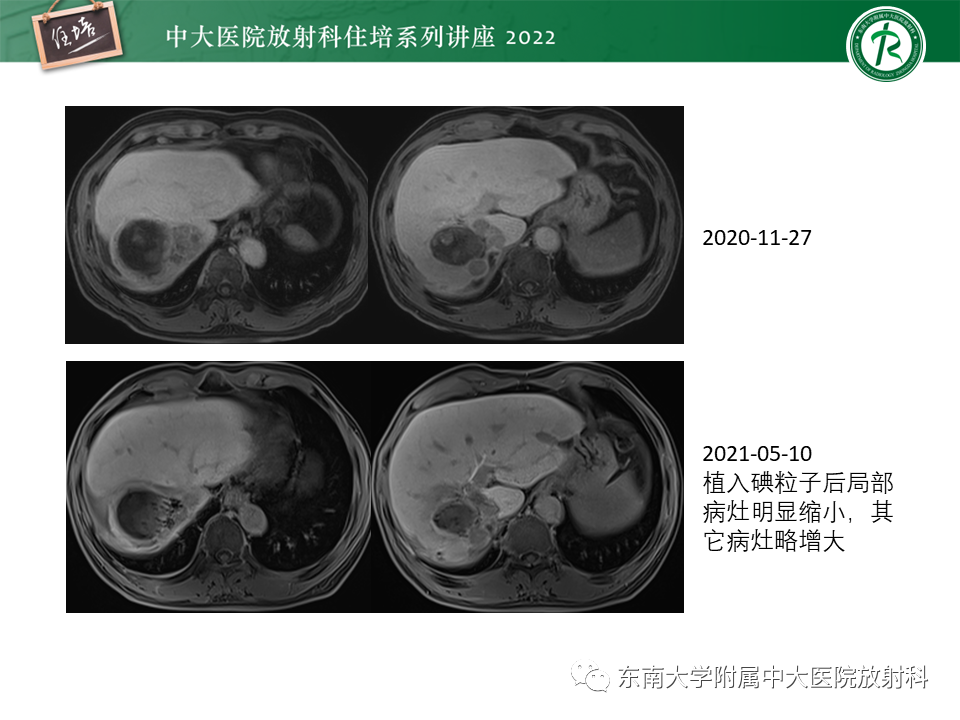影像PPT - 【PPT】肝癌介入治疗后的磁共振评估-42