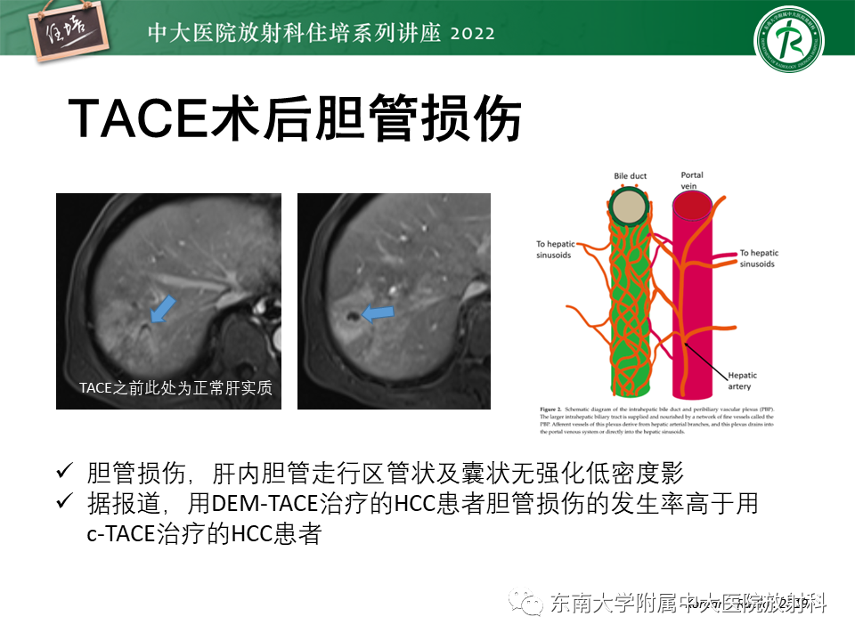影像PPT - 【PPT】肝癌介入治疗后的磁共振评估-44