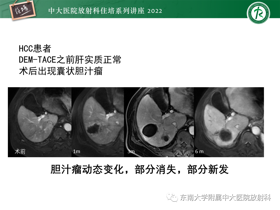 影像PPT - 【PPT】肝癌介入治疗后的磁共振评估-46