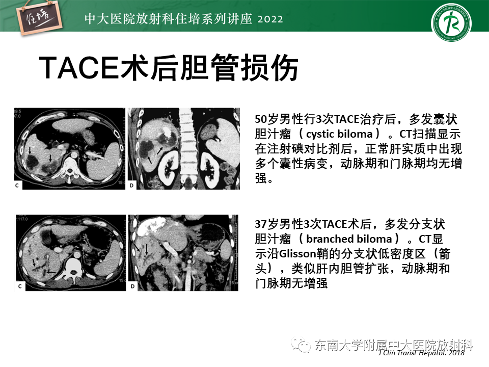 影像PPT - 【PPT】肝癌介入治疗后的磁共振评估-45