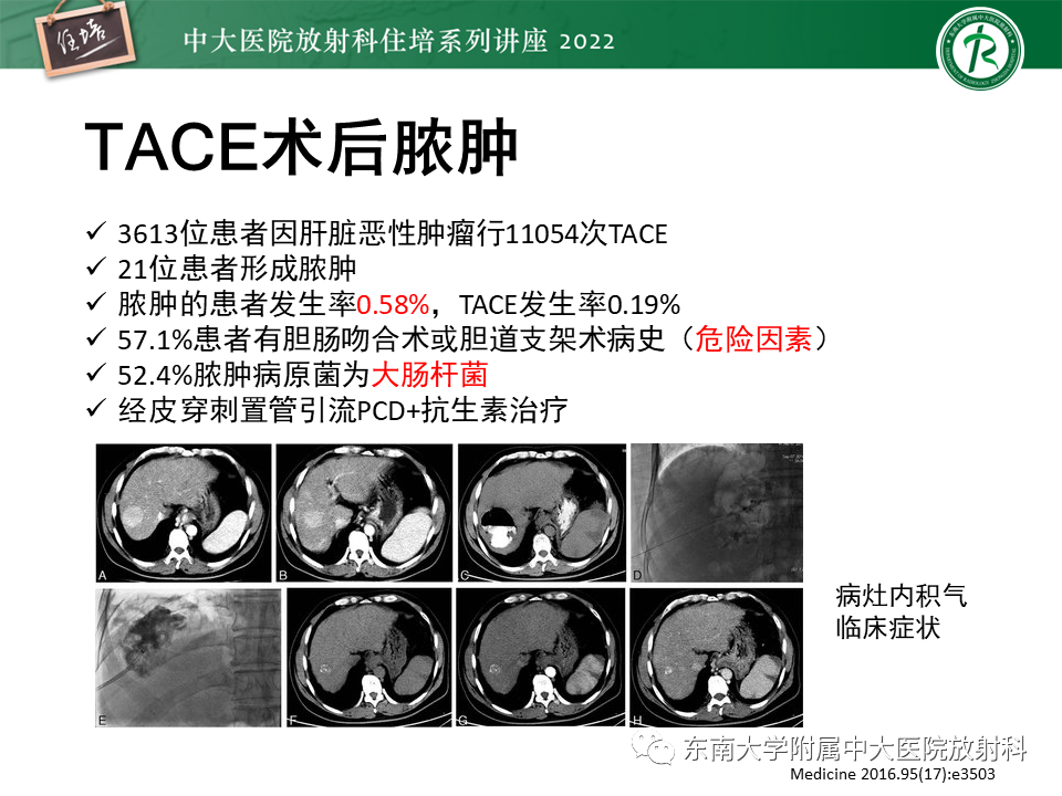 影像PPT - 【PPT】肝癌介入治疗后的磁共振评估-47