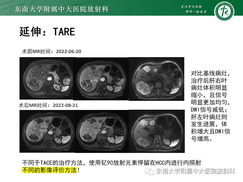 影像PPT - 【PPT】肝癌介入治疗后的磁共振评估-48