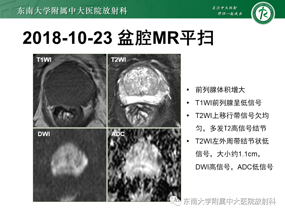 影像PPT - 【PPT】前列腺癌-3 影像PPT - 【PPT】前列腺癌-3
