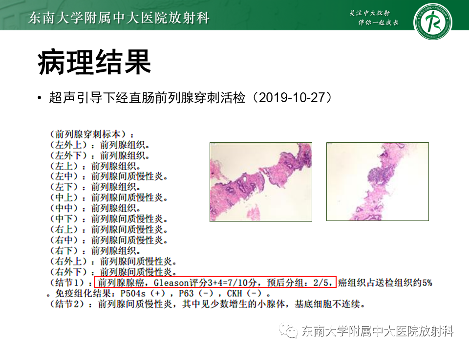 影像PPT - 【PPT】前列腺癌-5 影像PPT - 【PPT】前列腺癌-5