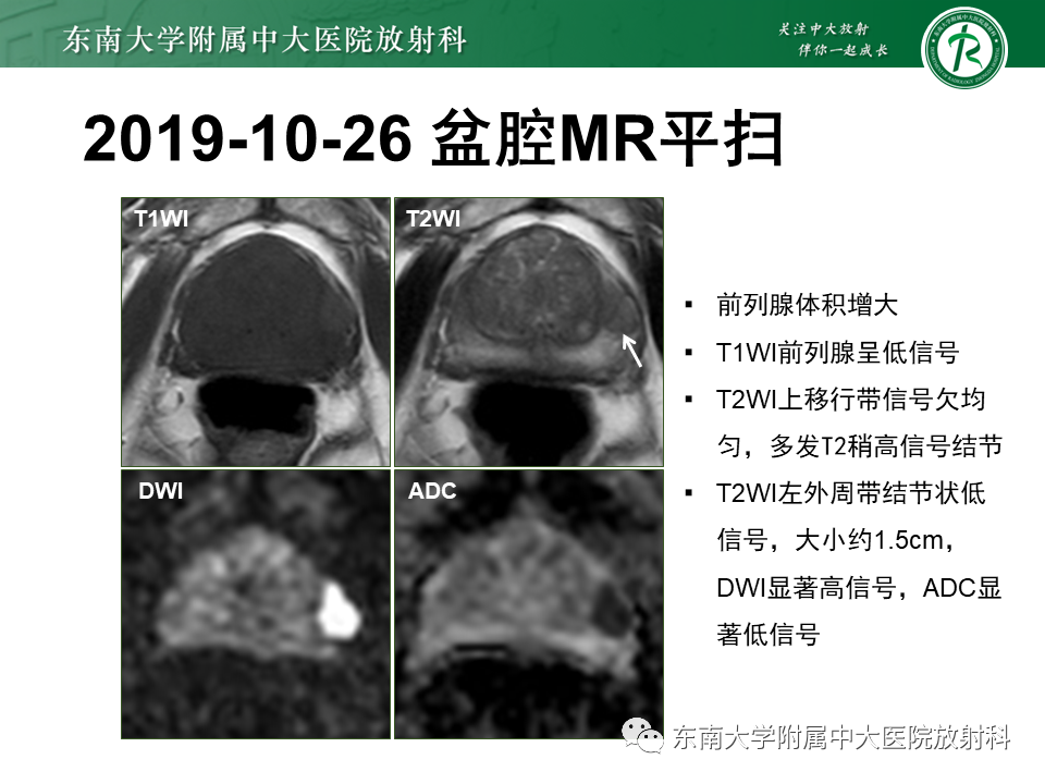 影像PPT - 【PPT】前列腺癌-4 影像PPT - 【PPT】前列腺癌-4