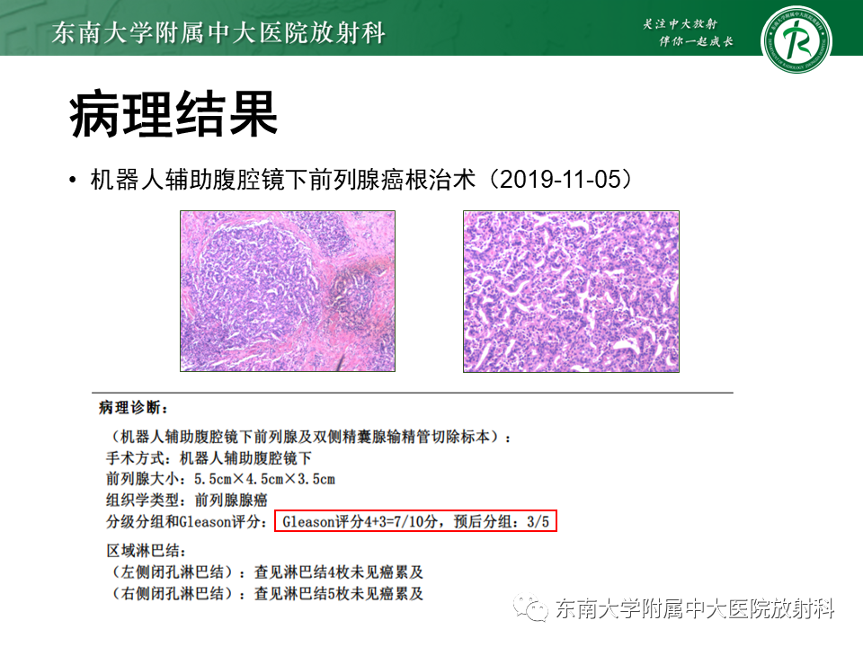 影像PPT - 【PPT】前列腺癌-6 影像PPT - 【PPT】前列腺癌-6