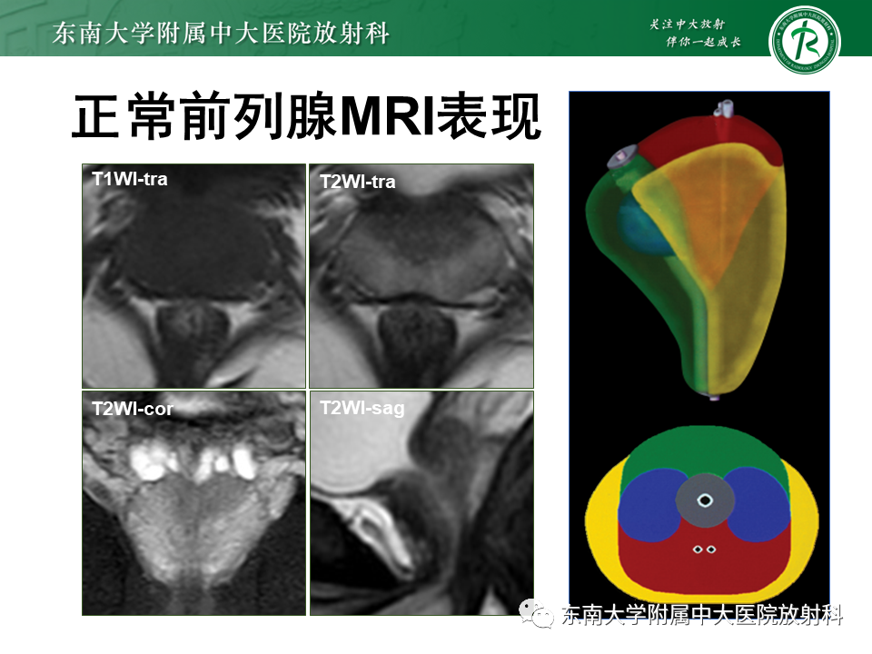 影像PPT - 【PPT】前列腺癌-11 影像PPT - 【PPT】前列腺癌-11