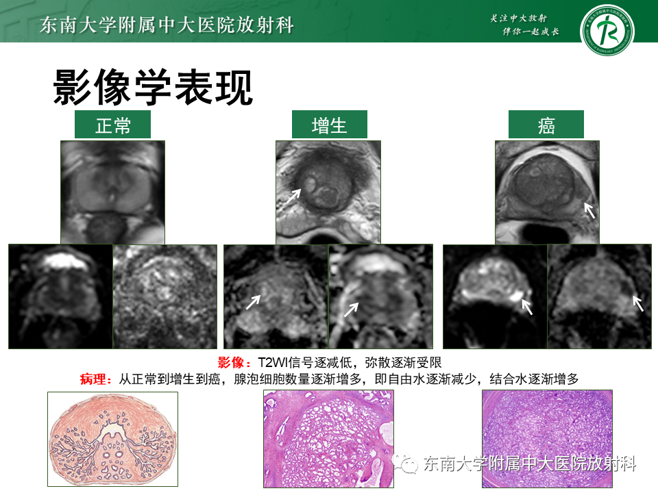 影像PPT - 【PPT】前列腺癌-13 影像PPT - 【PPT】前列腺癌-13