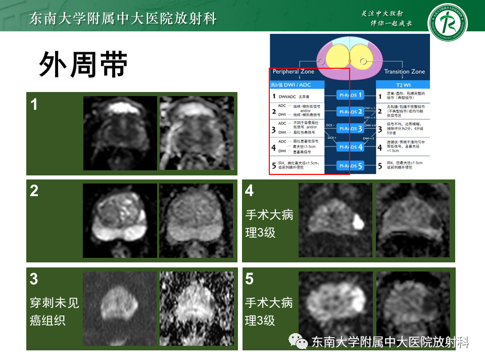 影像PPT - 【PPT】前列腺癌-16 影像PPT - 【PPT】前列腺癌-16