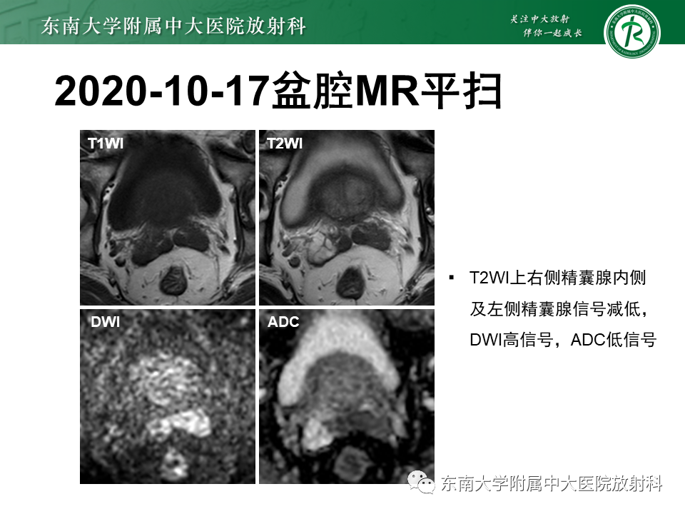 影像PPT - 【PPT】前列腺癌-19 影像PPT - 【PPT】前列腺癌-19