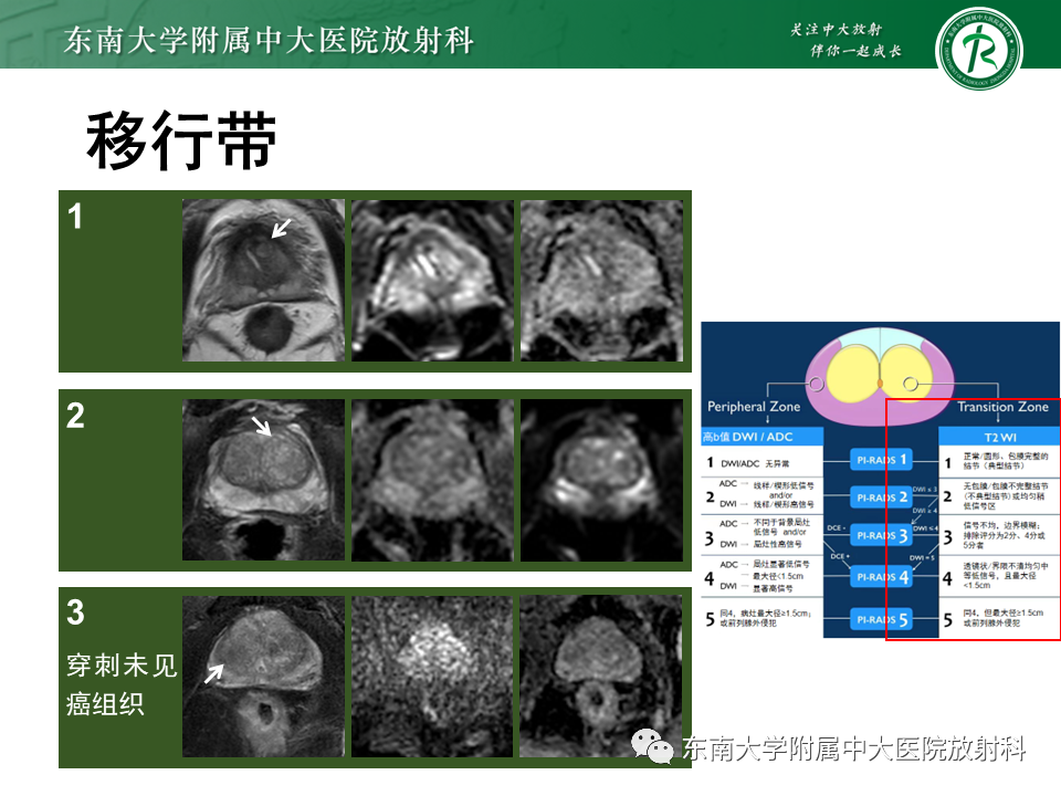 影像PPT - 【PPT】前列腺癌-21 影像PPT - 【PPT】前列腺癌-21