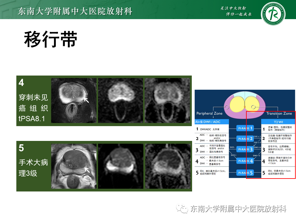 影像PPT - 【PPT】前列腺癌-22 影像PPT - 【PPT】前列腺癌-22