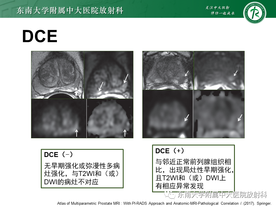 影像PPT - 【PPT】前列腺癌-23 影像PPT - 【PPT】前列腺癌-23