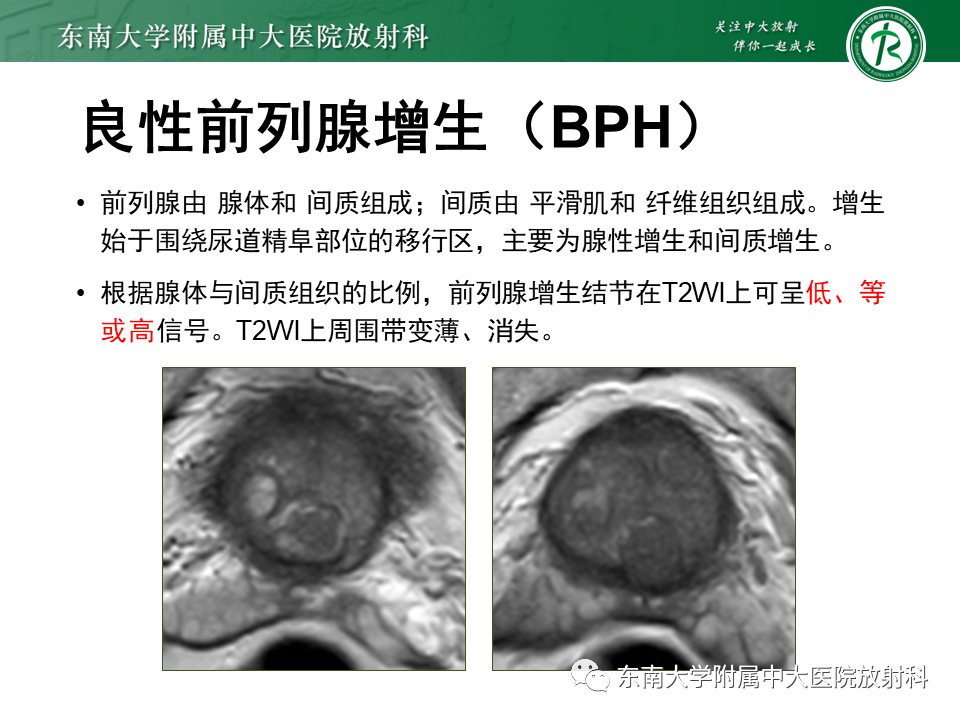 影像PPT - 【PPT】前列腺癌-25 影像PPT - 【PPT】前列腺癌-25