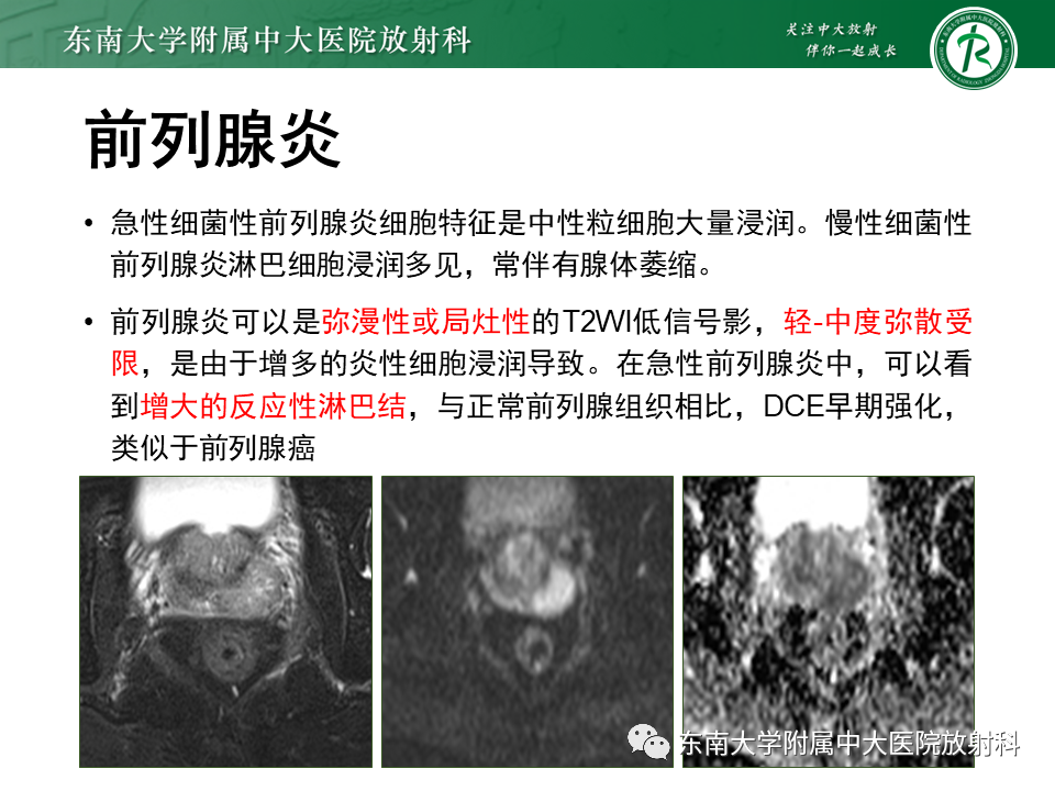 影像PPT - 【PPT】前列腺癌-26 影像PPT - 【PPT】前列腺癌-26