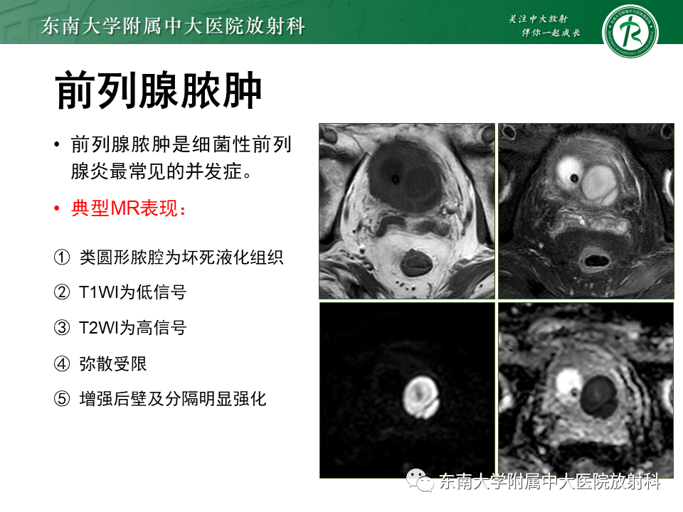 影像PPT - 【PPT】前列腺癌-27 影像PPT - 【PPT】前列腺癌-27