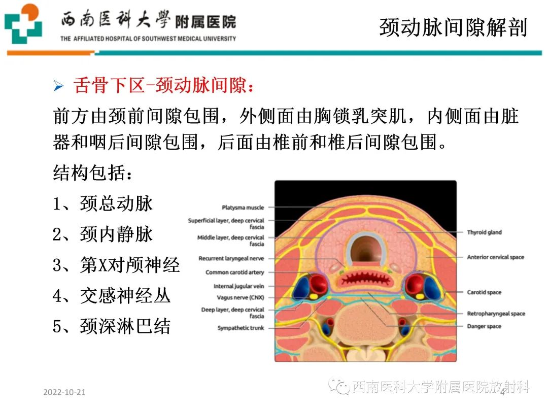 影像PPT - 【PPT】颈动脉间隙常见病变的影像诊断-4