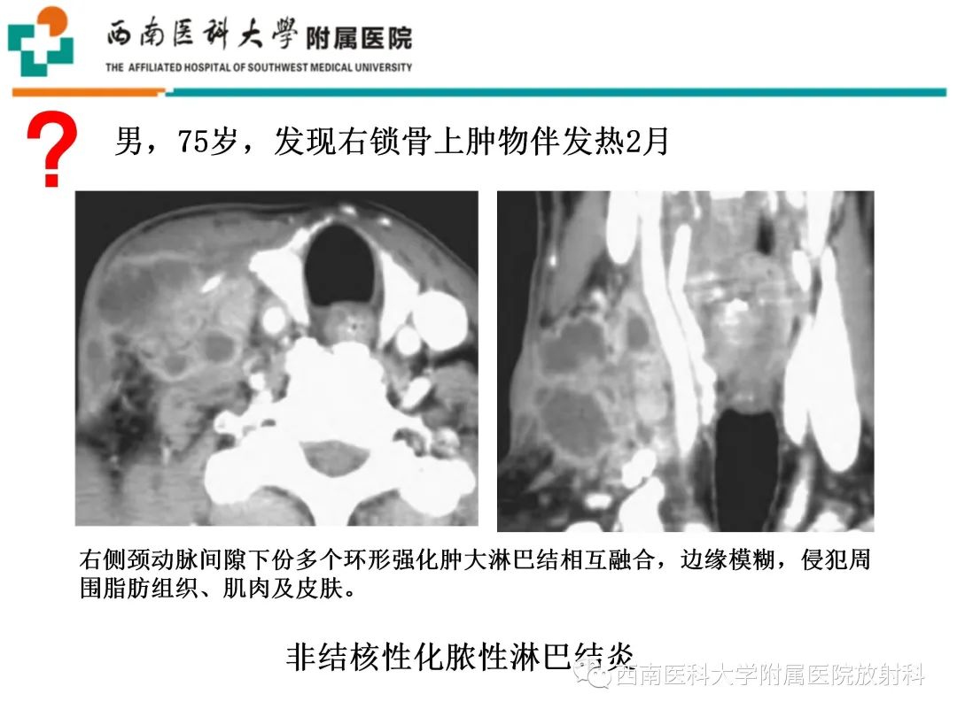 影像PPT - 【PPT】颈动脉间隙常见病变的影像诊断-7