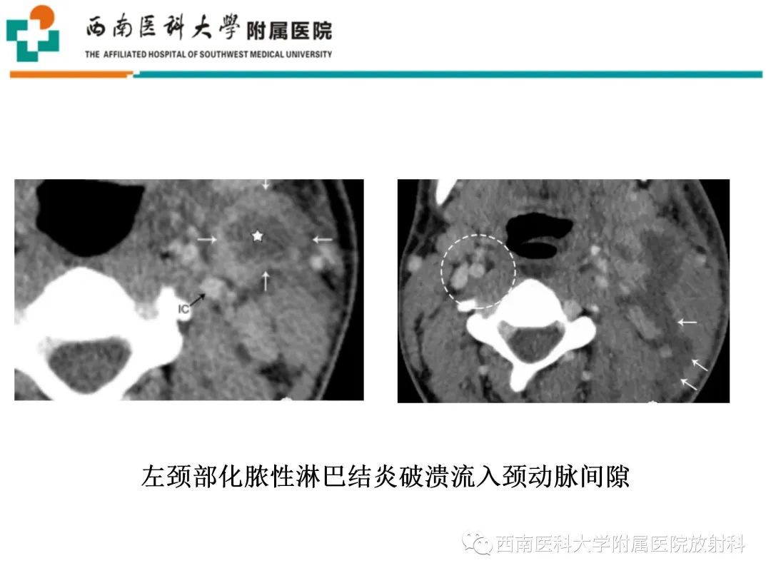 影像PPT - 【PPT】颈动脉间隙常见病变的影像诊断-9