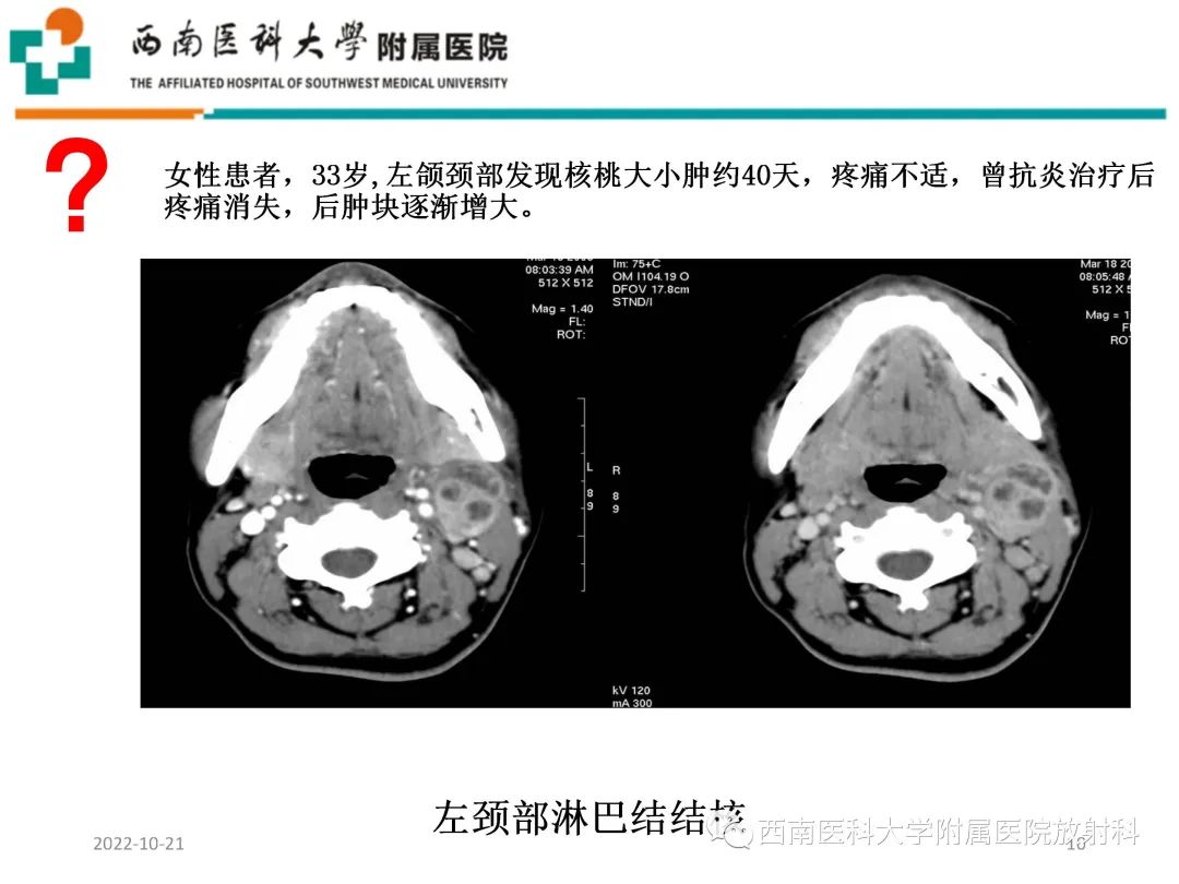 影像PPT - 【PPT】颈动脉间隙常见病变的影像诊断-10