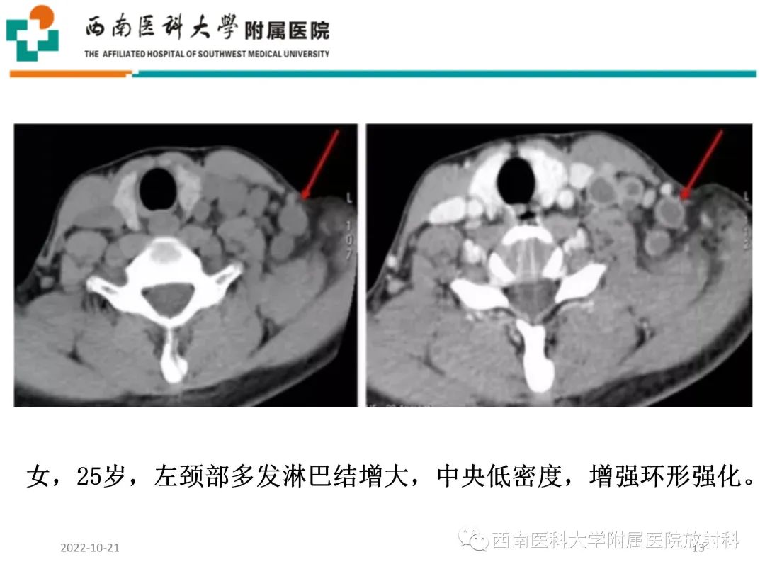 影像PPT - 【PPT】颈动脉间隙常见病变的影像诊断-13