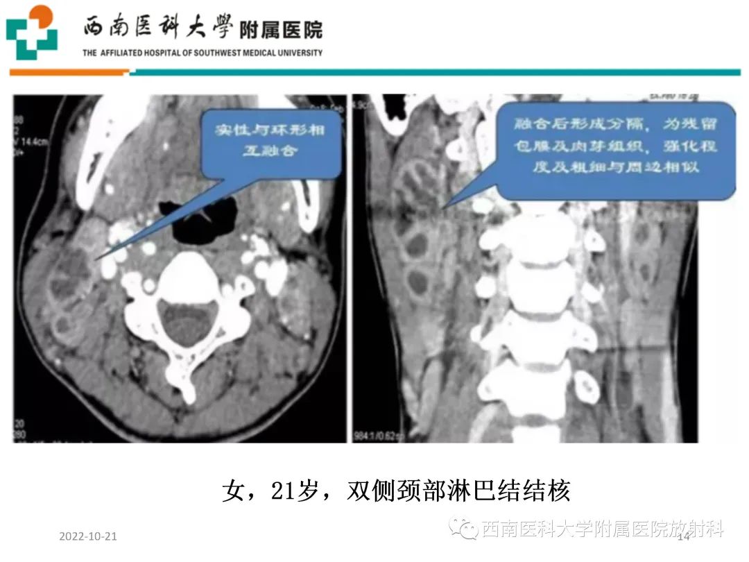影像PPT - 【PPT】颈动脉间隙常见病变的影像诊断-14