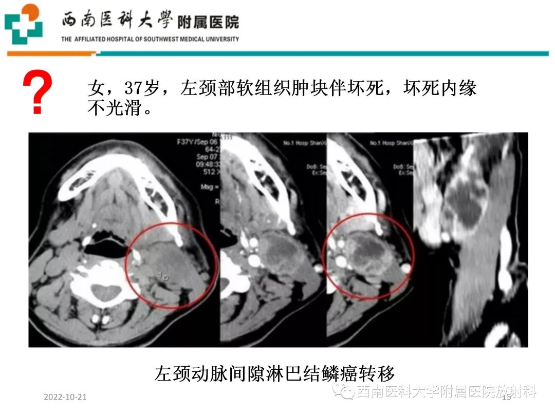 影像PPT - 【PPT】颈动脉间隙常见病变的影像诊断-15